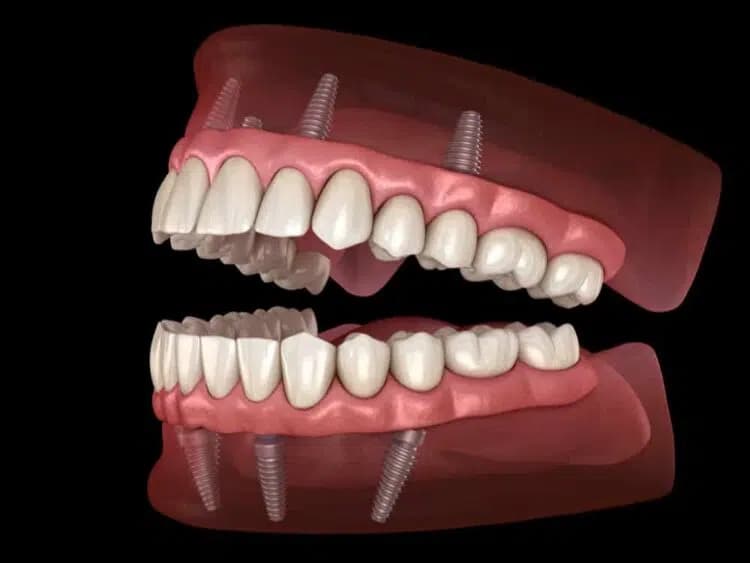 Implant-supported Dentures